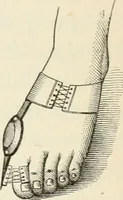 An illustration from A manual of modern surgery, general and operative : With 188 illus. in the text and 13 full-page plates in colors and tints, aggregating 276 separate figures. (1894)