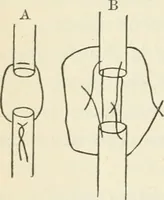 An illustration from A manual of modern surgery, general and operative : With 188 illus. in the text and 13 full-page plates in colors and tints, aggregating 276 separate figures. (1894)