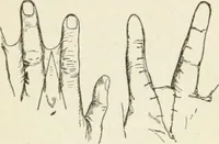 An illustration from A manual of modern surgery, general and operative : With 188 illus. in the text and 13 full-page plates in colors and tints, aggregating 276 separate figures. (1894)