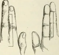An illustration from A manual of modern surgery, general and operative : With 188 illus. in the text and 13 full-page plates in colors and tints, aggregating 276 separate figures. (1894)