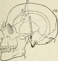 An illustration from A manual of modern surgery, general and operative : With 188 illus. in the text and 13 full-page plates in colors and tints, aggregating 276 separate figures. (1894)