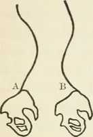 An illustration from A manual of modern surgery, general and operative : With 188 illus. in the text and 13 full-page plates in colors and tints, aggregating 276 separate figures. (1894)