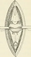 Picture 101 of 135 from A manual of modern surgery, general and operative : With 188 illus. in the text and 13 full-page plates in colors and tints, aggregating 276 separate figures. (1894), leaf 617