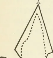 An illustration from A manual of modern surgery, general and operative : With 188 illus. in the text and 13 full-page plates in colors and tints, aggregating 276 separate figures. (1894)