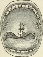 An illustration from A manual of modern surgery, general and operative : With 188 illus. in the text and 13 full-page plates in colors and tints, aggregating 276 separate figures. (1894)