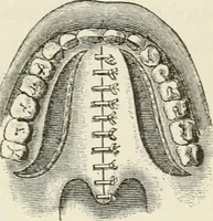 An illustration from A manual of modern surgery, general and operative : With 188 illus. in the text and 13 full-page plates in colors and tints, aggregating 276 separate figures. (1894)