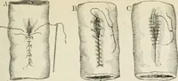 An illustration from A manual of modern surgery, general and operative : With 188 illus. in the text and 13 full-page plates in colors and tints, aggregating 276 separate figures. (1894)