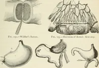 Picture 108 of 135 from A manual of modern surgery, general and operative : With 188 illus. in the text and 13 full-page plates in colors and tints, aggregating 276 separate figures. (1894), leaf 661