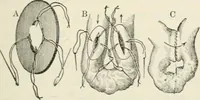 An illustration from A manual of modern surgery, general and operative : With 188 illus. in the text and 13 full-page plates in colors and tints, aggregating 276 separate figures. (1894)