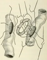 Picture 111 of 135 from A manual of modern surgery, general and operative : With 188 illus. in the text and 13 full-page plates in colors and tints, aggregating 276 separate figures. (1894), leaf 666