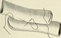 An illustration from A manual of modern surgery, general and operative : With 188 illus. in the text and 13 full-page plates in colors and tints, aggregating 276 separate figures. (1894)