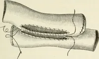 An illustration from A manual of modern surgery, general and operative : With 188 illus. in the text and 13 full-page plates in colors and tints, aggregating 276 separate figures. (1894)