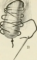 An illustration from A manual of modern surgery, general and operative : With 188 illus. in the text and 13 full-page plates in colors and tints, aggregating 276 separate figures. (1894)