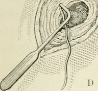 Picture 115 of 135 from A manual of modern surgery, general and operative : With 188 illus. in the text and 13 full-page plates in colors and tints, aggregating 276 separate figures. (1894), leaf 673