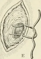 An illustration from A manual of modern surgery, general and operative : With 188 illus. in the text and 13 full-page plates in colors and tints, aggregating 276 separate figures. (1894)