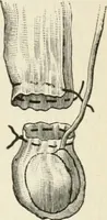 An illustration from A manual of modern surgery, general and operative : With 188 illus. in the text and 13 full-page plates in colors and tints, aggregating 276 separate figures. (1894)