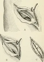 An illustration from A manual of modern surgery, general and operative : With 188 illus. in the text and 13 full-page plates in colors and tints, aggregating 276 separate figures. (1894)