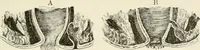An illustration from A manual of modern surgery, general and operative : With 188 illus. in the text and 13 full-page plates in colors and tints, aggregating 276 separate figures. (1894)
