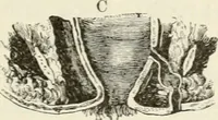 An illustration from A manual of modern surgery, general and operative : With 188 illus. in the text and 13 full-page plates in colors and tints, aggregating 276 separate figures. (1894)