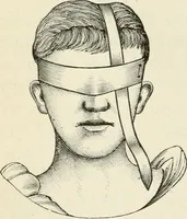Picture 124 of 135 from A manual of modern surgery, general and operative : With 188 illus. in the text and 13 full-page plates in colors and tints, aggregating 276 separate figures. (1894), leaf 718