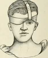 An illustration from A manual of modern surgery, general and operative : With 188 illus. in the text and 13 full-page plates in colors and tints, aggregating 276 separate figures. (1894)