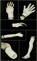 An illustration from A manual of modern surgery, general and operative : With 188 illus. in the text and 13 full-page plates in colors and tints, aggregating 276 separate figures. (1894)