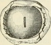 An illustration from A manual of modern surgery, general and operative : With 188 illus. in the text and 13 full-page plates in colors and tints, aggregating 276 separate figures. (1894)