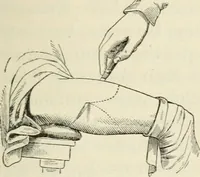 An illustration from A manual of modern surgery, general and operative : With 188 illus. in the text and 13 full-page plates in colors and tints, aggregating 276 separate figures. (1894)