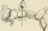 An illustration from A manual of modern surgery, general and operative : With 188 illus. in the text and 13 full-page plates in colors and tints, aggregating 276 separate figures. (1894)