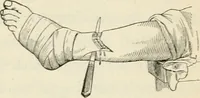 An illustration from A manual of modern surgery, general and operative : With 188 illus. in the text and 13 full-page plates in colors and tints, aggregating 276 separate figures. (1894)