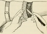 An illustration from A manual of modern surgery, general and operative : With 188 illus. in the text and 13 full-page plates in colors and tints, aggregating 276 separate figures. (1894)