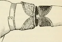 Picture 134 of 135 from A manual of modern surgery, general and operative : With 188 illus. in the text and 13 full-page plates in colors and tints, aggregating 276 separate figures. (1894), leaf 803