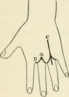 An illustration from A manual of modern surgery, general and operative : With 188 illus. in the text and 13 full-page plates in colors and tints, aggregating 276 separate figures. (1894)