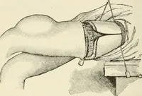 An illustration from A manual of modern surgery, general and operative : With 188 illus. in the text and 13 full-page plates in colors and tints, aggregating 276 separate figures. (1894)