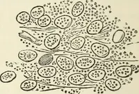 An illustration from A manual of modern surgery, general and operative : With 188 illus. in the text and 13 full-page plates in colors and tints, aggregating 276 separate figures. (1894)