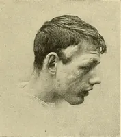 An illustration from Mental diseases : A text-book of psychiatry for medical students and practitioners / by R.H. Cole, ... With fifty-two illustrations and plates. (1913)