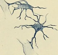 An illustration from Mental diseases : A text-book of psychiatry for medical students and practitioners / by R.H. Cole, ... With fifty-two illustrations and plates. (1913)
