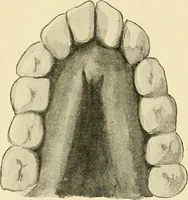 An illustration from Mental diseases : A text-book of psychiatry for medical students and practitioners / by R.H. Cole, ... With fifty-two illustrations and plates. (1913)