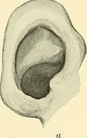 An illustration from Mental diseases : A text-book of psychiatry for medical students and practitioners / by R.H. Cole, ... With fifty-two illustrations and plates. (1913)