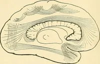 An illustration from Mental diseases : A text-book of psychiatry for medical students and practitioners / by R.H. Cole, ... With fifty-two illustrations and plates. (1913)