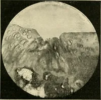 An illustration from Diseases of metabolism and of the blood : animal parasites, toxicology / ed. by Richard C. Cabot ... An authorized translation from "Die deutsche klinik" under the general editorial supervision of Julius L. Salinger, M. D. With one colored plate and fifty-eight illustrations in the text. (1906)