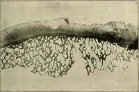 An illustration from Diseases of metabolism and of the blood : animal parasites, toxicology / ed. by Richard C. Cabot ... An authorized translation from "Die deutsche klinik" under the general editorial supervision of Julius L. Salinger, M. D. With one colored plate and fifty-eight illustrations in the text. (1906)