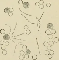 An illustration from Diseases of metabolism and of the blood : animal parasites, toxicology / ed. by Richard C. Cabot ... An authorized translation from "Die deutsche klinik" under the general editorial supervision of Julius L. Salinger, M. D. With one colored plate and fifty-eight illustrations in the text. (1906)