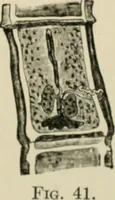 Picture 26 of 36 from Diseases of metabolism and of the blood : animal parasites, toxicology / ed. by Richard C. Cabot ... An authorized translation from "Die deutsche klinik" under the general editorial supervision of Julius L. Salinger, M. D. With one colored plate and fifty-eight illustrations in the text. (1906), leaf 541