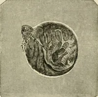 An illustration from Diseases of metabolism and of the blood : animal parasites, toxicology / ed. by Richard C. Cabot ... An authorized translation from "Die deutsche klinik" under the general editorial supervision of Julius L. Salinger, M. D. With one colored plate and fifty-eight illustrations in the text. (1906)