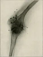 An illustration from Bismuth paste in chronic suppurations : its diagnostic importance and therapeutic value / by Emil G. Beck ... with an introduction by Carl Beck, M. D., and a chapter on the application of bismuth paste in the treatment of chronic suppuration of the nasal accessory sinuses and the ear, by Joseph C. Beck, M. D. With eighty-one engravings, nine diagrammatic illustrations, and a colored plate. (1914)