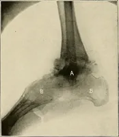 An illustration from Bismuth paste in chronic suppurations : its diagnostic importance and therapeutic value / by Emil G. Beck ... with an introduction by Carl Beck, M. D., and a chapter on the application of bismuth paste in the treatment of chronic suppuration of the nasal accessory sinuses and the ear, by Joseph C. Beck, M. D. With eighty-one engravings, nine diagrammatic illustrations, and a colored plate. (1914)