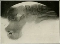 An illustration from Bismuth paste in chronic suppurations : its diagnostic importance and therapeutic value / by Emil G. Beck ... with an introduction by Carl Beck, M. D., and a chapter on the application of bismuth paste in the treatment of chronic suppuration of the nasal accessory sinuses and the ear, by Joseph C. Beck, M. D. With eighty-one engravings, nine diagrammatic illustrations, and a colored plate. (1914)
