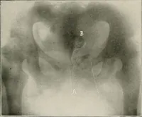An illustration from Bismuth paste in chronic suppurations : its diagnostic importance and therapeutic value / by Emil G. Beck ... with an introduction by Carl Beck, M. D., and a chapter on the application of bismuth paste in the treatment of chronic suppuration of the nasal accessory sinuses and the ear, by Joseph C. Beck, M. D. With eighty-one engravings, nine diagrammatic illustrations, and a colored plate. (1914)