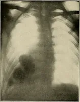 An illustration from Bismuth paste in chronic suppurations : its diagnostic importance and therapeutic value / by Emil G. Beck ... with an introduction by Carl Beck, M. D., and a chapter on the application of bismuth paste in the treatment of chronic suppuration of the nasal accessory sinuses and the ear, by Joseph C. Beck, M. D. With eighty-one engravings, nine diagrammatic illustrations, and a colored plate. (1914)